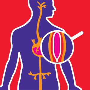 Video: Angioplasty